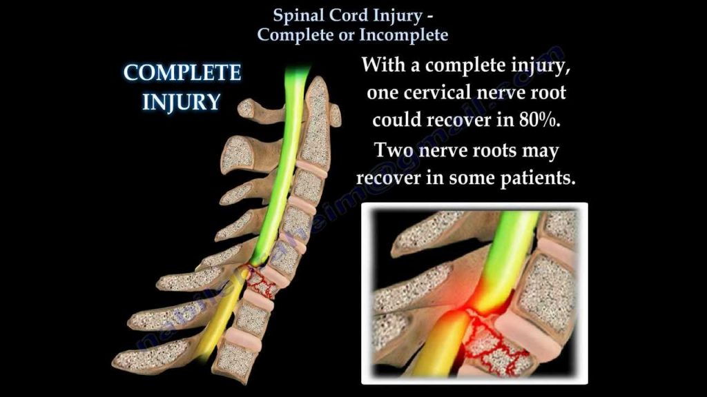 Spinal Injuries, Explained - Spine Paris